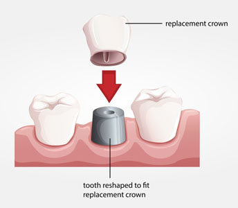 What You Should Know About Dental Crowns And Bridges