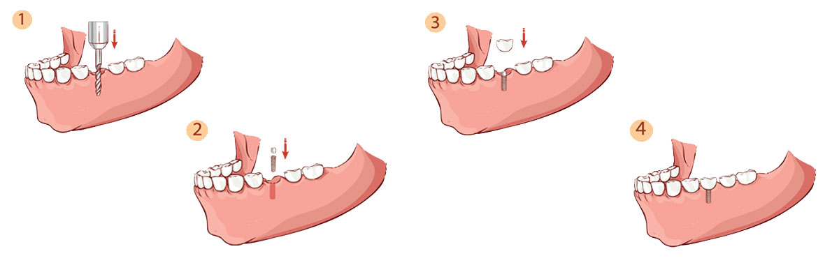 Armonk The Dental Implant Procedure