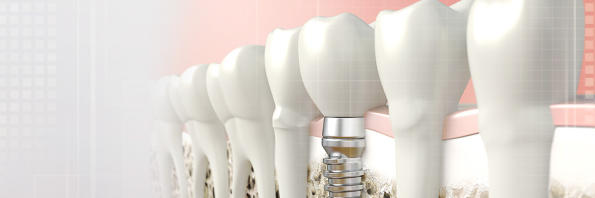 Armonk Implant Dentist