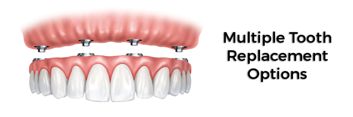 Armonk Multiple Teeth Replacement Options