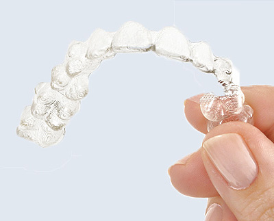 7 Things Parents Need to Know About Invisalign Teen