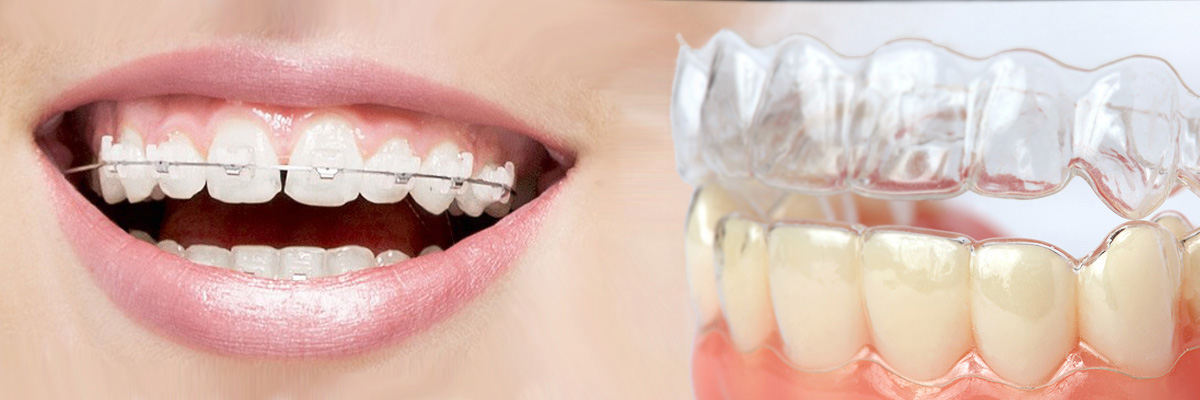 Armonk Which is Better Invisalign or Braces